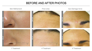 Dermoabrasión <span class=keywords><strong>agua</strong></span> oxígeno <span class=keywords><strong>terapia</strong></span> facial peeling máquina para la piel - Product Image 5