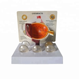 Giải Phẫu Mắt Người Đục Thủy Tinh Thể Mô Hình - Product Image 1