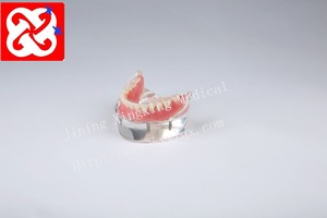 Onderkaak overkappingsprothese implant tanden model met 4 implantaten