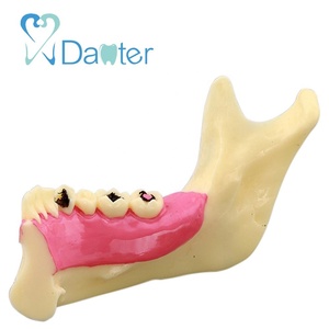 Modelo de Mandíbula Más Vendido para Mostrar Impactos, Caries y Abscesos - Product Image 3