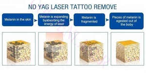 Picosegundo profesional portátil 1064nm/532nm <span class=keywords><strong>Nd</strong></span> <span class=keywords><strong>Yag</strong></span> Eliminación de tatuajes con láser - Product Image 3
