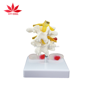 Giảng dạy Y Tế 2 Mô Hình Bộ Xương đốt sống thắt lưng với thoát vị và đĩa đệm intervertebral - Product Image 2