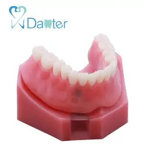 最新的覆盖义齿模型与 2 植入物牙科模型的示范
