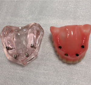 Educatief Bovenste Onderkaak Implant Model Tanden Overkappingsprothese Model met 4 implantaten - Product Image 4