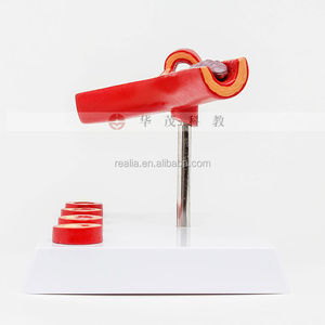 HM-BD-082 Aterosklerosis Model Anatomi Aterosklerosis Model Anatomi Medis Aterosklerosis Model - Product Image 3