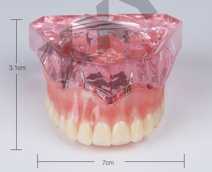 Bovenkaak Overkappingsprothese Restauratie Model Met 4 Implantaten Prothese Model - Product Image 6