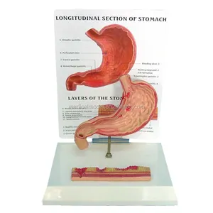 Human Ulcer Stomach Model With Description Plate