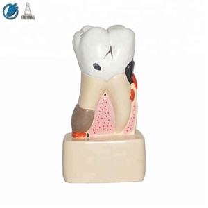Modello dentale di patologia della carie umana 4 volte - Product Image 4