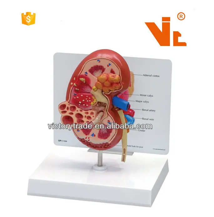V-AM035 Plastik anatomie Menschliche Organe Nieren zysten modell