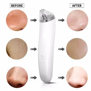 Electric vacuum suction pimple comedone extractor pore cleaning device,handheld blackhead removal tool set