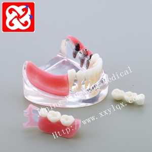Partial denture implant และฟื้นฟู jaw รุ่น