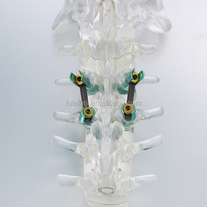 5.5 Titanyum <span class=keywords><strong>Spinal</strong></span> Vida Sistemi Ayarlanabilir Konnektör Ortopedik Omurga İmplantı - Product Image 2
