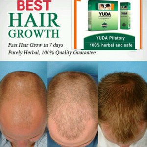 Spray para el Crecimiento del Cabello con Tu Propia Marca, Producto en Oferta, Botella OEM, Detiene la Caída del Cabello en 7 Días - Product Image 2