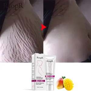 RtopR Natural Herbal Mango Anti Scar Cream Anti Wrinkle Maternity Repair Firming Fast Effective Anti Stretch Marks Cream