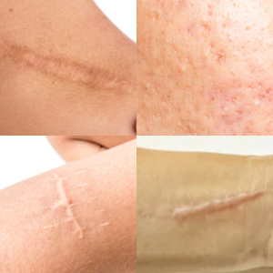 Láminas de Silicona Autoadhesivas e Impermeables para Cicatrices, Certificación CE, Estériles Clase I, Venta al por Mayor para Cicatrices Faciales, Consumibles Médicos - Product Image 3