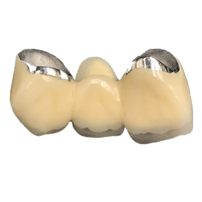Dental Lab Kunstmatige Tand Vaste Prothese Pfm 3D Metalen Gedrukt Porselein Valse Tanden
