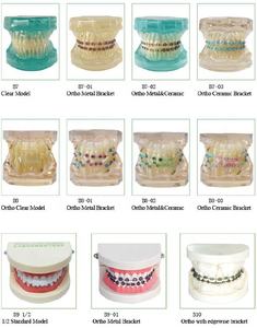 Modello dentale Ortodontico Con staffe in metallo - Product Image 6