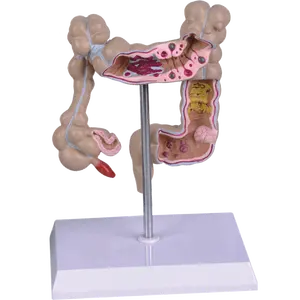 Modelo patológico de Colon y recto