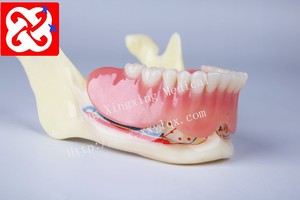 Prothese implantaat en restauratie anatomisch kaak model - Product Image 5