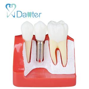 2018 Hot Koop Implant Analyse <span class=keywords><strong>Model</strong></span> Hars Verwijderbare <span class=keywords><strong>Dental</strong></span> Implant Tanden