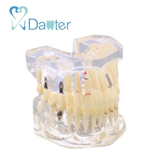 Nieuwe mode van 2 keer implant en restauratie model voor tonen cariës, cyste, wortel breuk, impactie, tandsteen, enkele kroon - Product Image 1