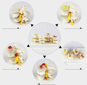 Modè<span class=keywords><strong>le</strong></span> de démonstration des vertèbres lombaires normales <span class=keywords><strong>et</strong></span> malades, processus de pathologie des disques intervertébraux <span class=keywords><strong>et</strong></span> des lésions vertébrales lombaires - Product Image 1