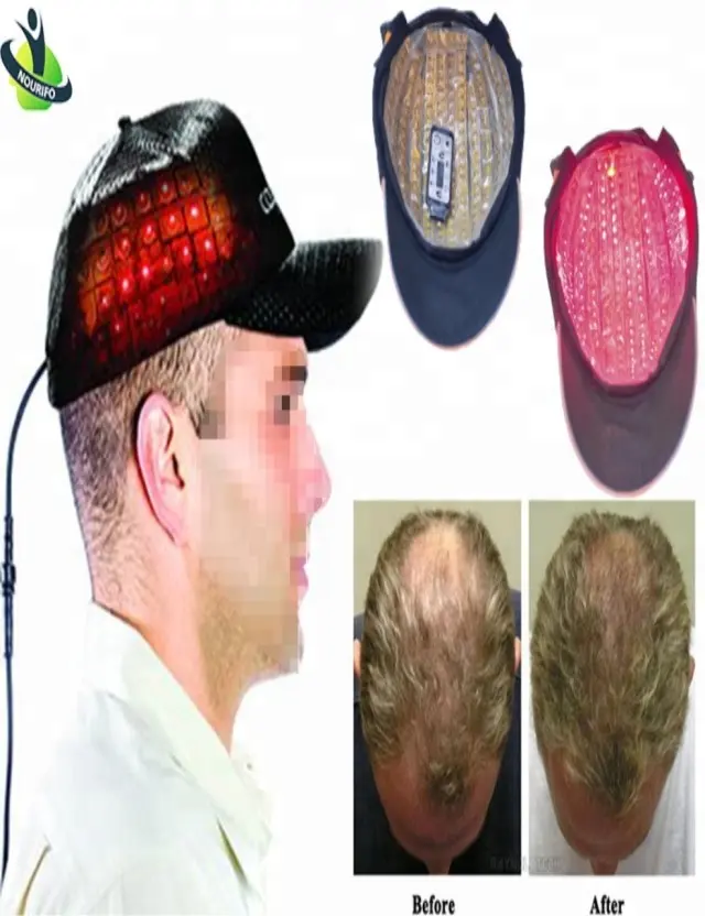 ダイオードレーザーキャップ育毛、レーザー脱毛治療、ヘアオイル制御