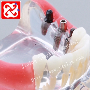 Partial denture implant และฟื้นฟู jaw รุ่น