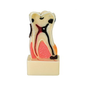 Gelsonlab HSDT-C17 4 Vezes a doença periodontal Modelo Dos Dentes - Product Image 5