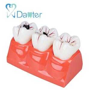 Nuovo Tipo Dentale Denti Carie Modello Patologico Modello per <span class=keywords><strong>Dental</strong></span> Studio
