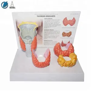 Medical Thyroid pathological model