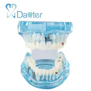 Malattia dentale Rimovibile Dimostrazione di Studio Insegnamento Denti Modello per I Dentisti e Scuole - Product Image 3