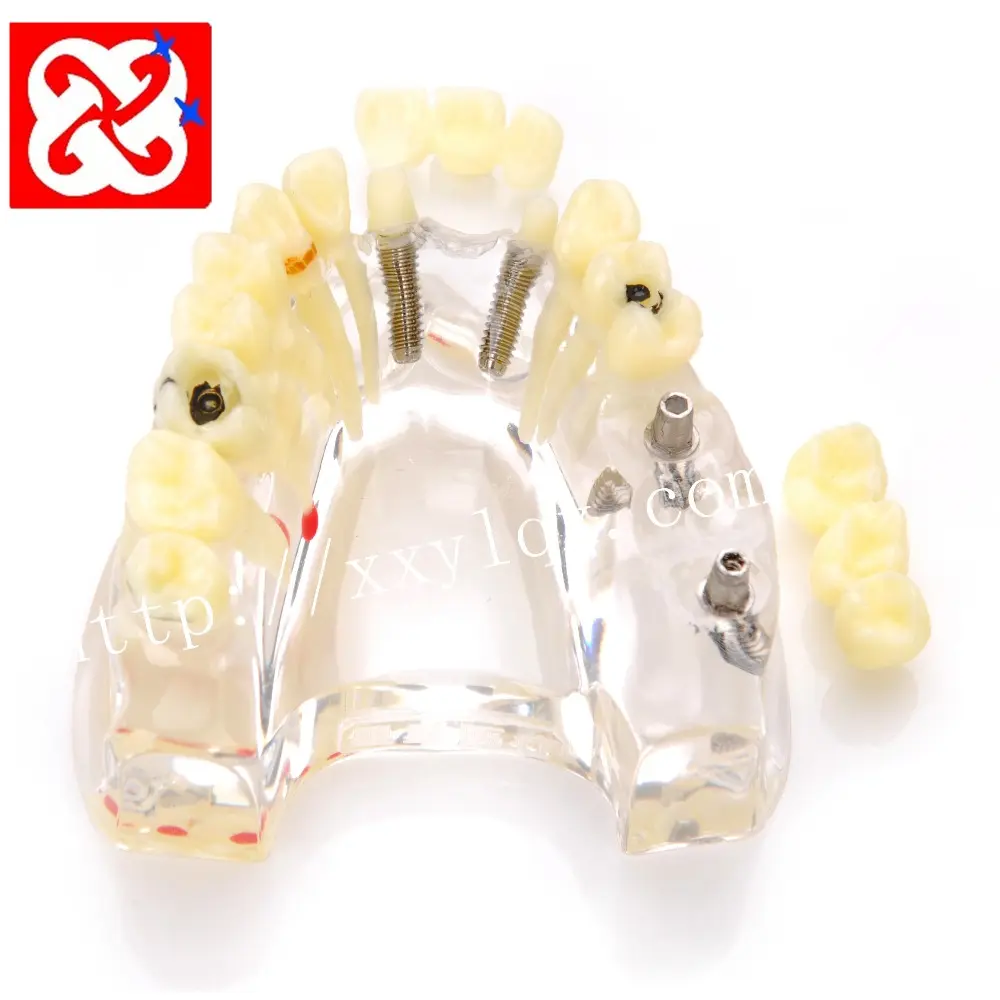 Implant and restoration Dental model upper half