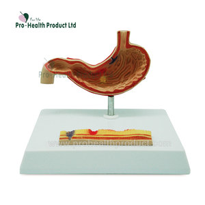 Patients Education Pathological Disease Stomach Anatomy Model