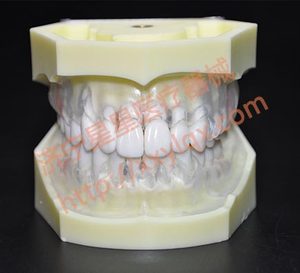 Peroidontal malattia dentale modello con trasparente sereno gum demostrates ginivae recessione - Product Image 4