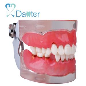 Gigi Periodontal Model dengan Penggantian Gingivitis Gigi Model Pengajaran - Product Image 3