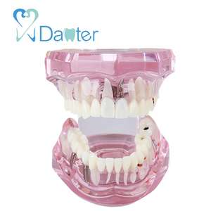 Malattia dentale Rimovibile Dimostrazione di Studio Insegnamento Denti Modello per I Dentisti e Scuole - Product Image 2