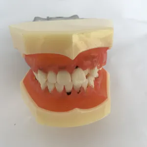 Severamente inflamada gengiva periodontal modelo dp articulador dental