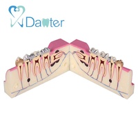 Modelo de estudio de sección transversal molar de resina de alta calidad para demostrar el absceso de impactación pulpa saludable Vs enferma buena Vs mala
