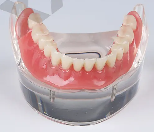 Mandibular overdenture restoration dental model with 2 implants
