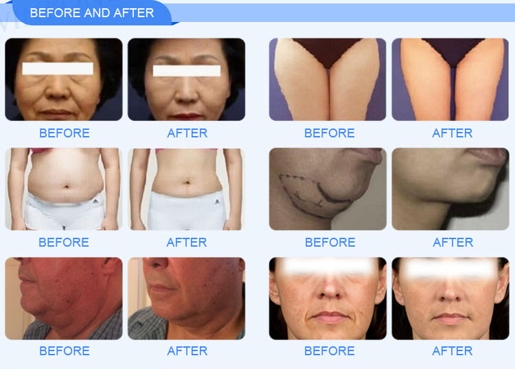 3D Hifu Face Machine 11 Lines Facial Anti Aging Slimming Body Machine