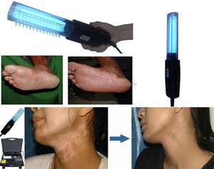 Produk baru lampu Uvb Band sempit genggam fototerapi 311 pita sempit untuk Vitiligo, <span class=keywords><strong>Psoriasis</strong></span>, Dermatitis, perawatan eksim
