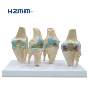 Modèle de genou pour l'arthrite, modèle des articulations du genou à 4 étages - Product Image 2