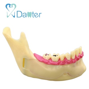 Modelo de Mandíbula Más Vendido para Mostrar Impactos, Caries y Abscesos - Product Image 2