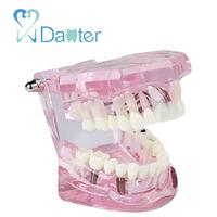 A2001 transparente implante dental modelo Restauración y patologías Dental estudio paciente Modelo de Educación
