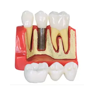 Gelsonlab HSDT-M3 4 Volte <span class=keywords><strong>Implant</strong></span> Denti Modello Dentale Modello di Impianto Analisi <span class=keywords><strong>Crown</strong></span> Ponte Dimostrazione Denti Modello per la Formazione - Product Image 1