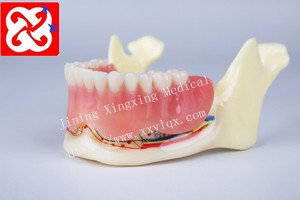 Prothese implantaat en restauratie anatomisch kaak model - Product Image 3