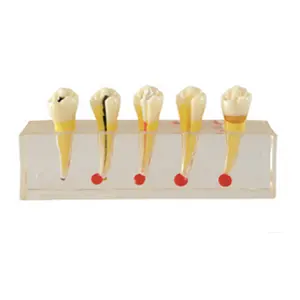 Gelsonlabe HSDT-M5 Dental Pulp Ziekte Klinische Tanden Model Tanden Pulp Ziekte Klinische Model Voor Tanden Onderwijs Leren