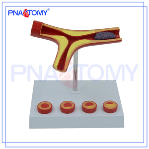 Modelo de PNT-0725 DE LA terioseslerosis con trombo a la venta - Product Image 5