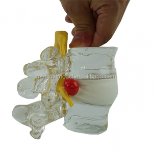 Kristall Wirbel Simulator Bandscheibenvorfall Modell - Product Image 1